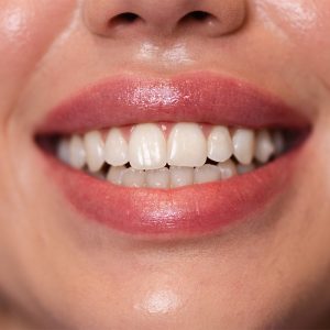 LaniDental_Izbjeljivanje