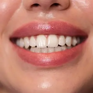 LaniDental_Izbjeljivanje