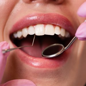 LaniDental_Ljuskice