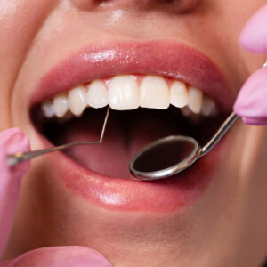 LaniDental_Ljuskice
