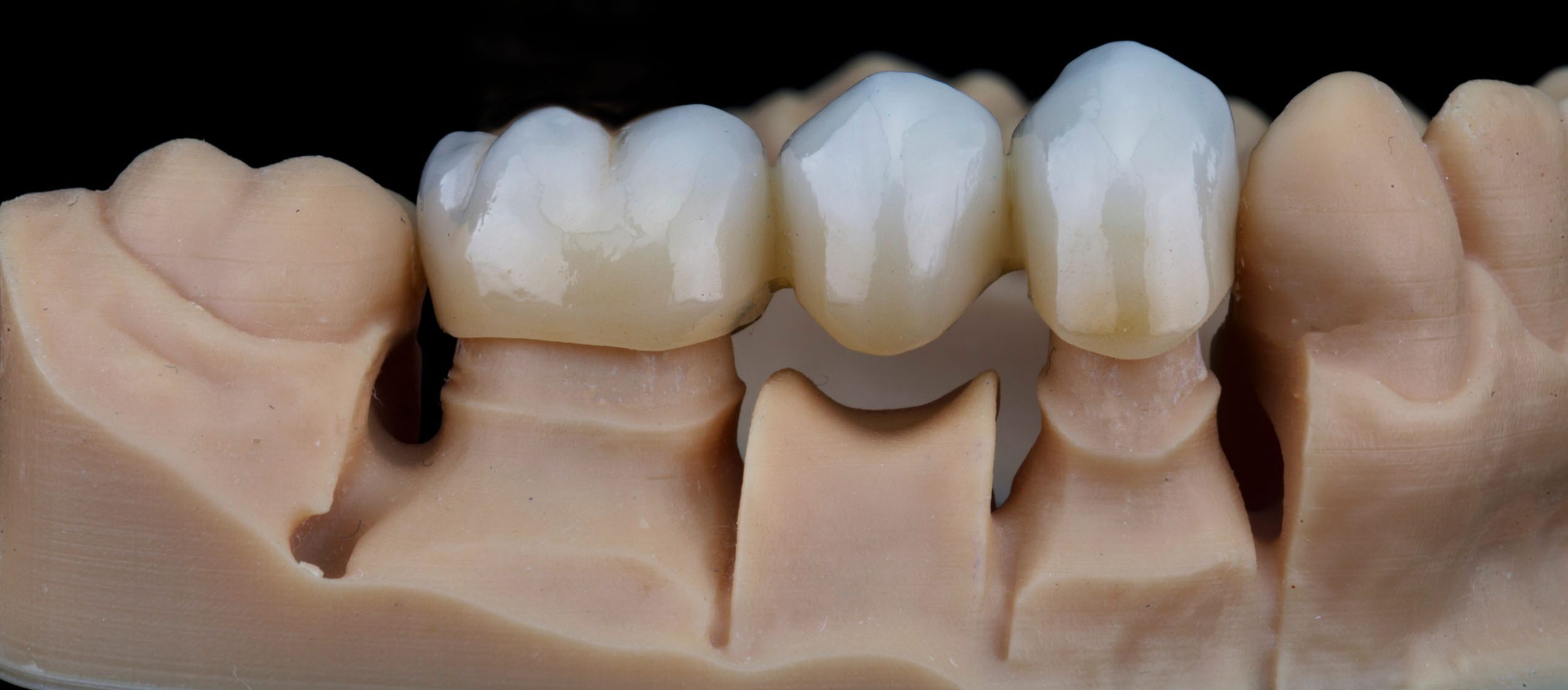 Zirconium,Dental,Crowns,On,A,Model,Made,On,A,3d zirconium dental crowns on a model made on a 3D printer, shot on black glass with reflection